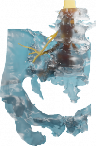 Pelvic Fracture Model
