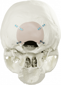 PEEK Occipital Implant