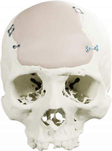 PEEK Overlay Implant