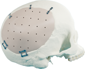 PEEK Cranial Implant