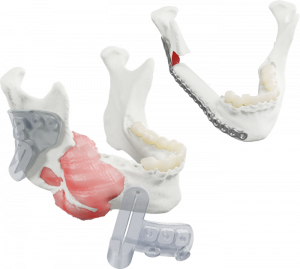 AccuPlan Reconstruction
