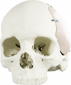 PEEK Pterional Implant