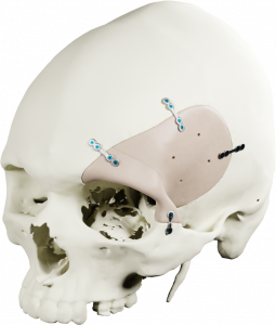 PEEK Orbital Implant