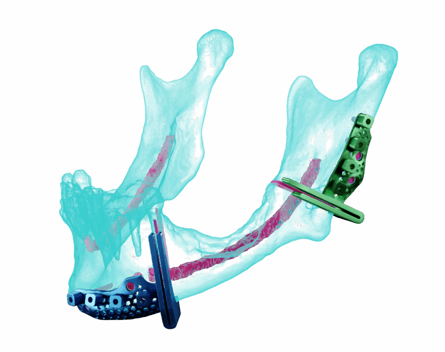 AccuPlan