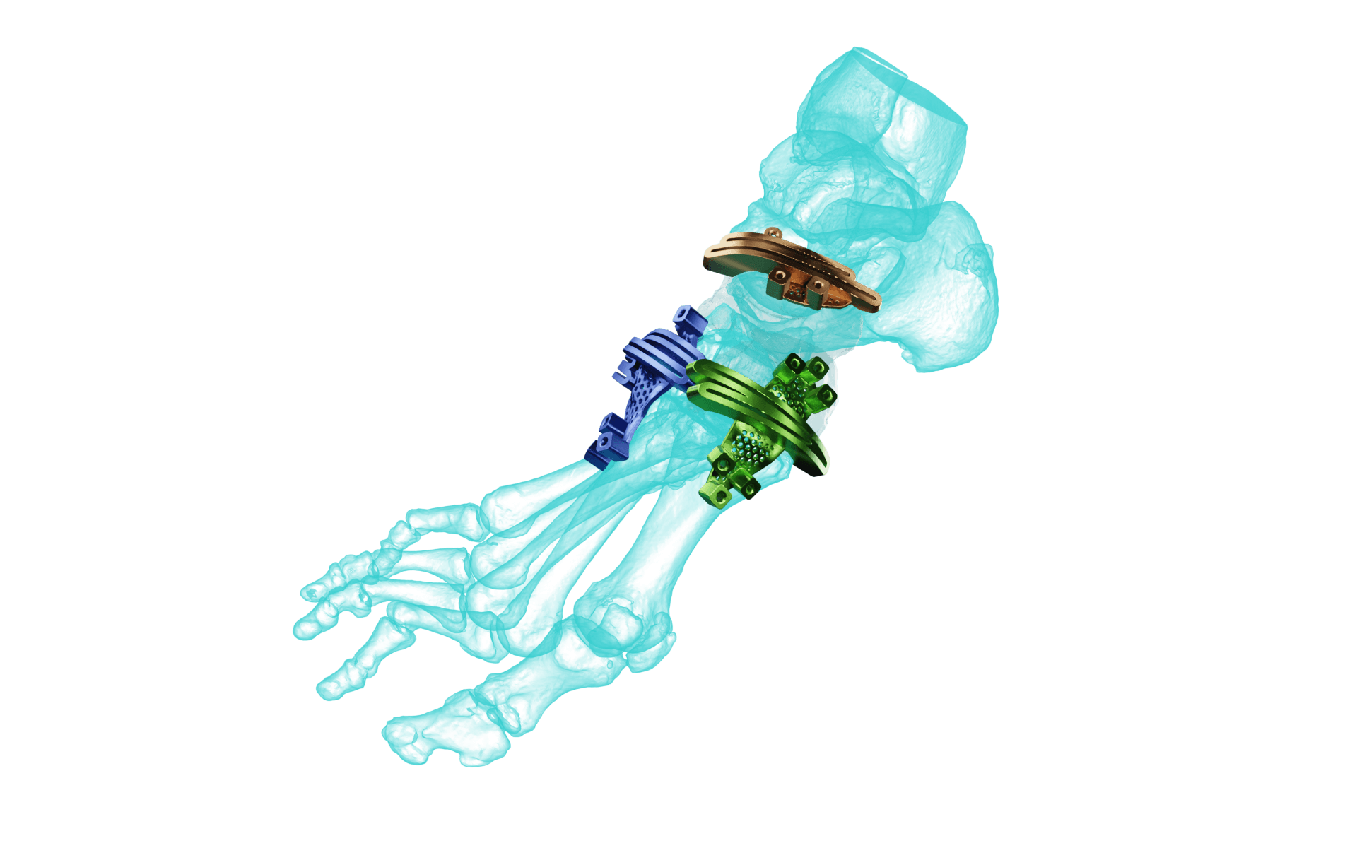 AccuStride® Foot + Ankle System