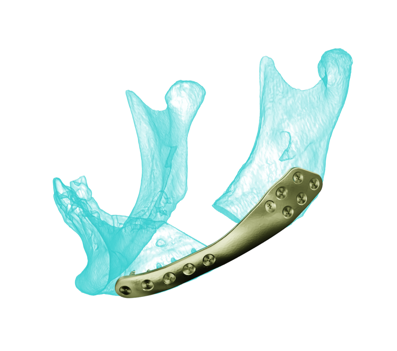 AccuPlan & AccuPlate